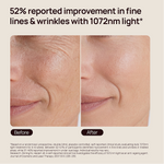 Before-and-after close-up of cheek and mouth; “52% reported improvement in fine lines & wrinkles with 1072nm light*”