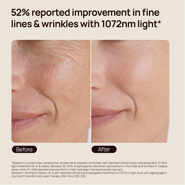 Before-and-after close-up of cheek and mouth; “52% reported improvement in fine lines & wrinkles with 1072nm light*”