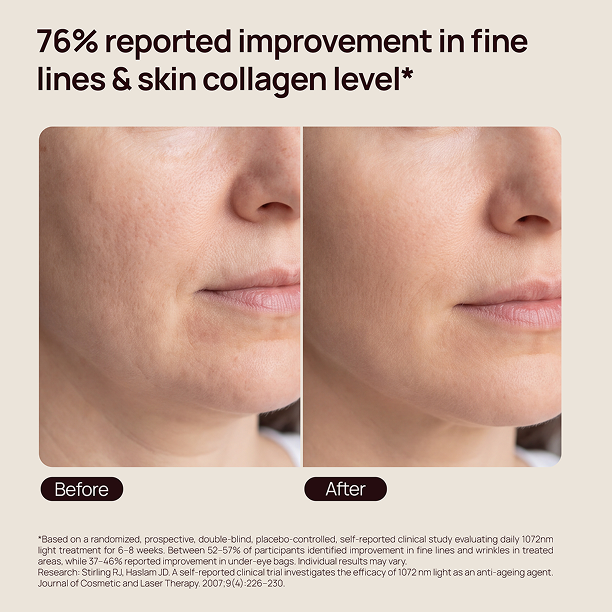 Before-and-after facial close-ups with text: “76% reported improvement in fine lines & skin collagen level*”