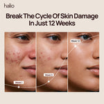 Break The Cycle Of Skin Damage In Just 12 Weeks