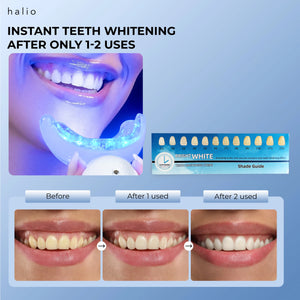 INSTANT TEETH WHITENING AFTER ONLY 1-2 USES - Before - After 1 use - After 2 uses