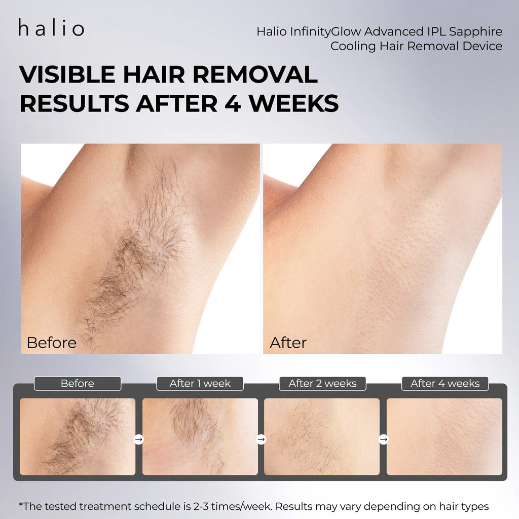 Halio InfinityGlow Advanced IPL Sapphire Cooling Hair Removal Device - Visible hair removal results after 4 weeks - Before - After - After 1 week - After 2 weeks - After 4 weeks