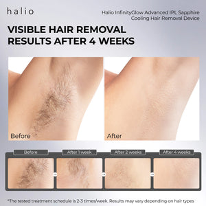 Halio InfinityGlow Advanced IPL Sapphire Cooling Hair Removal Device - Visible hair removal results after 4 weeks - Before - After - After 1 week - After 2 weeks - After 4 weeks