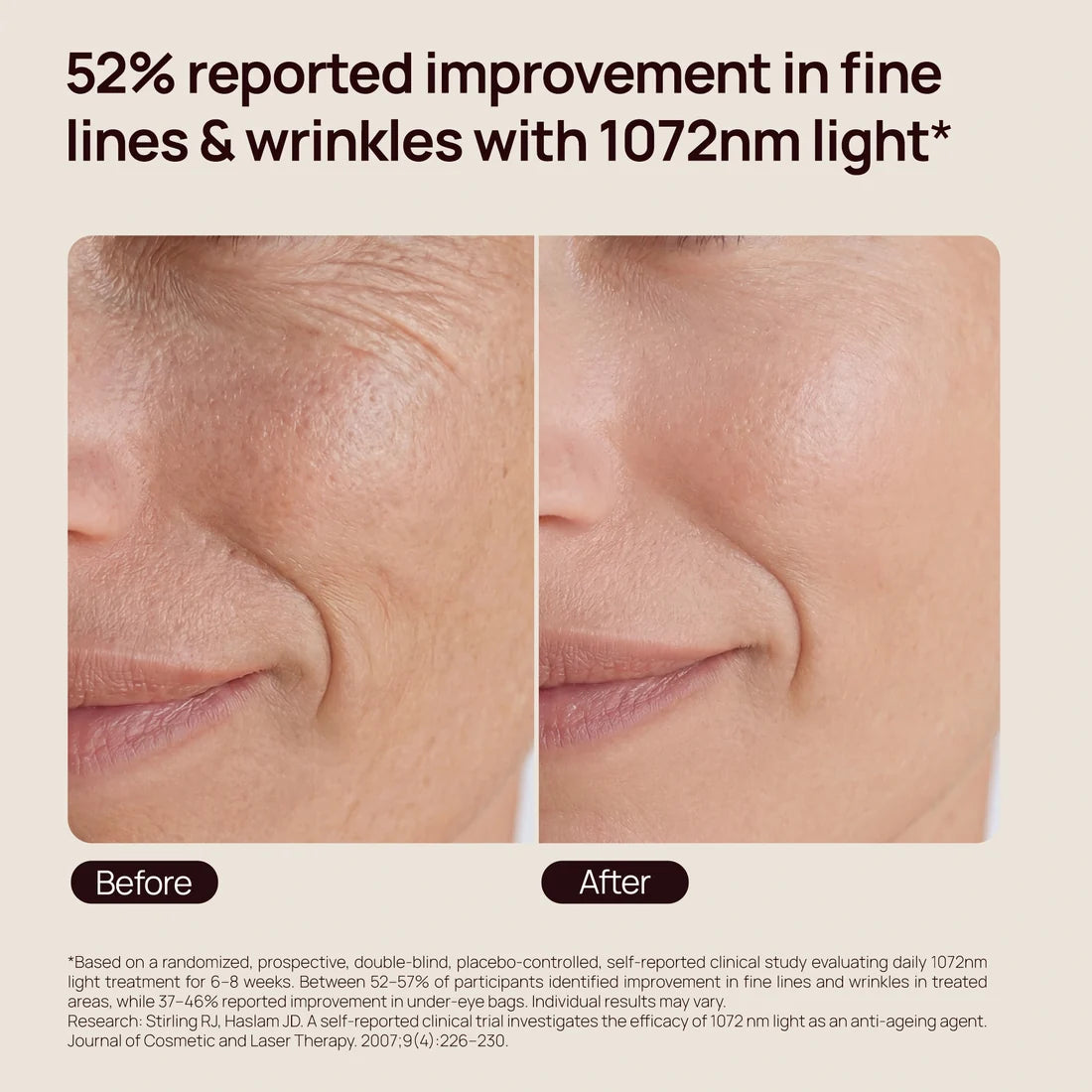 “52% reported improvement in fine lines & wrinkles with 1072nm light*; before-and-after cheek comparison”